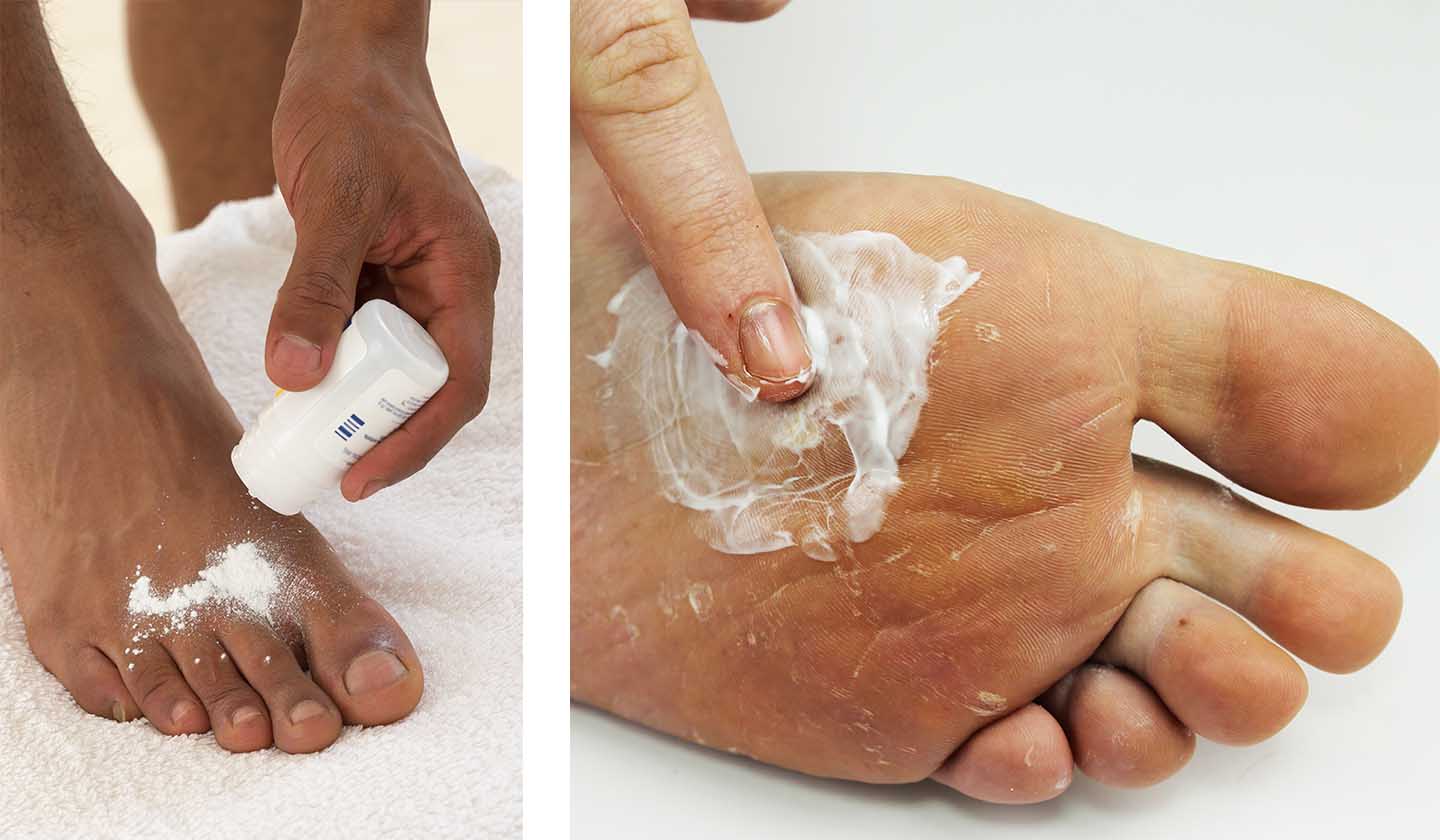 Tratamentos antifúngicos tópicos