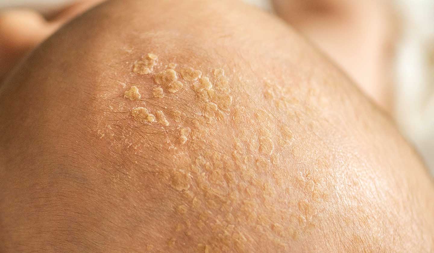Aparecimento de crostas na cabeça do bebé