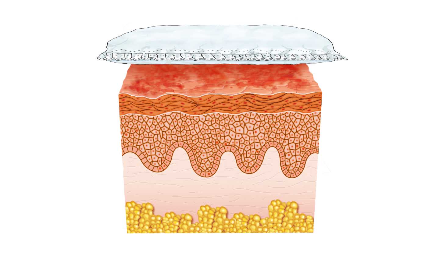 Skin reaction to nappy rash