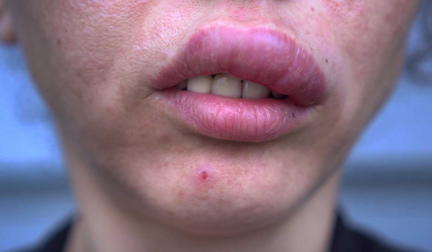 Sintomas do choque anafilático