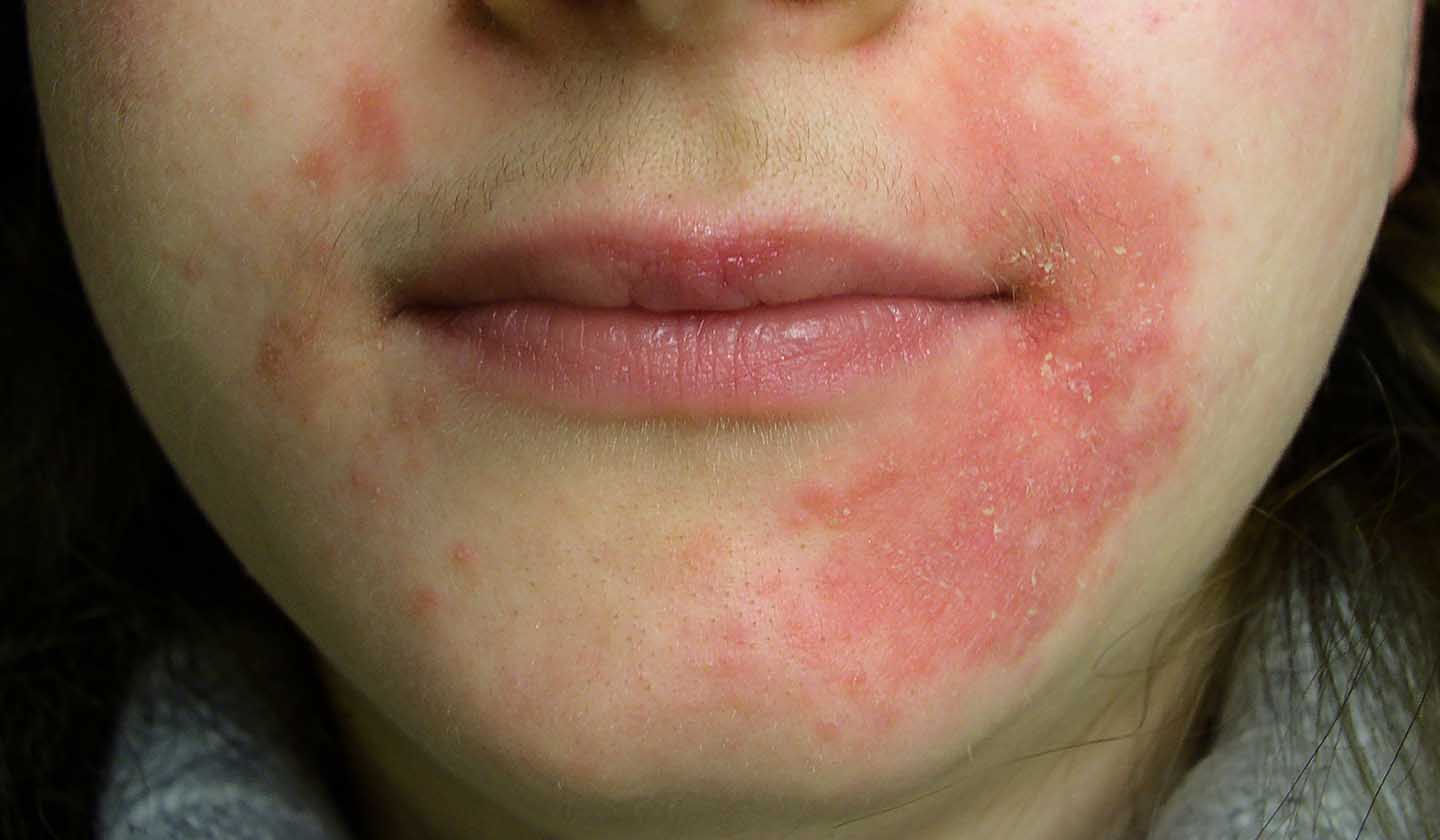 Dermatite perioral - Sintomas