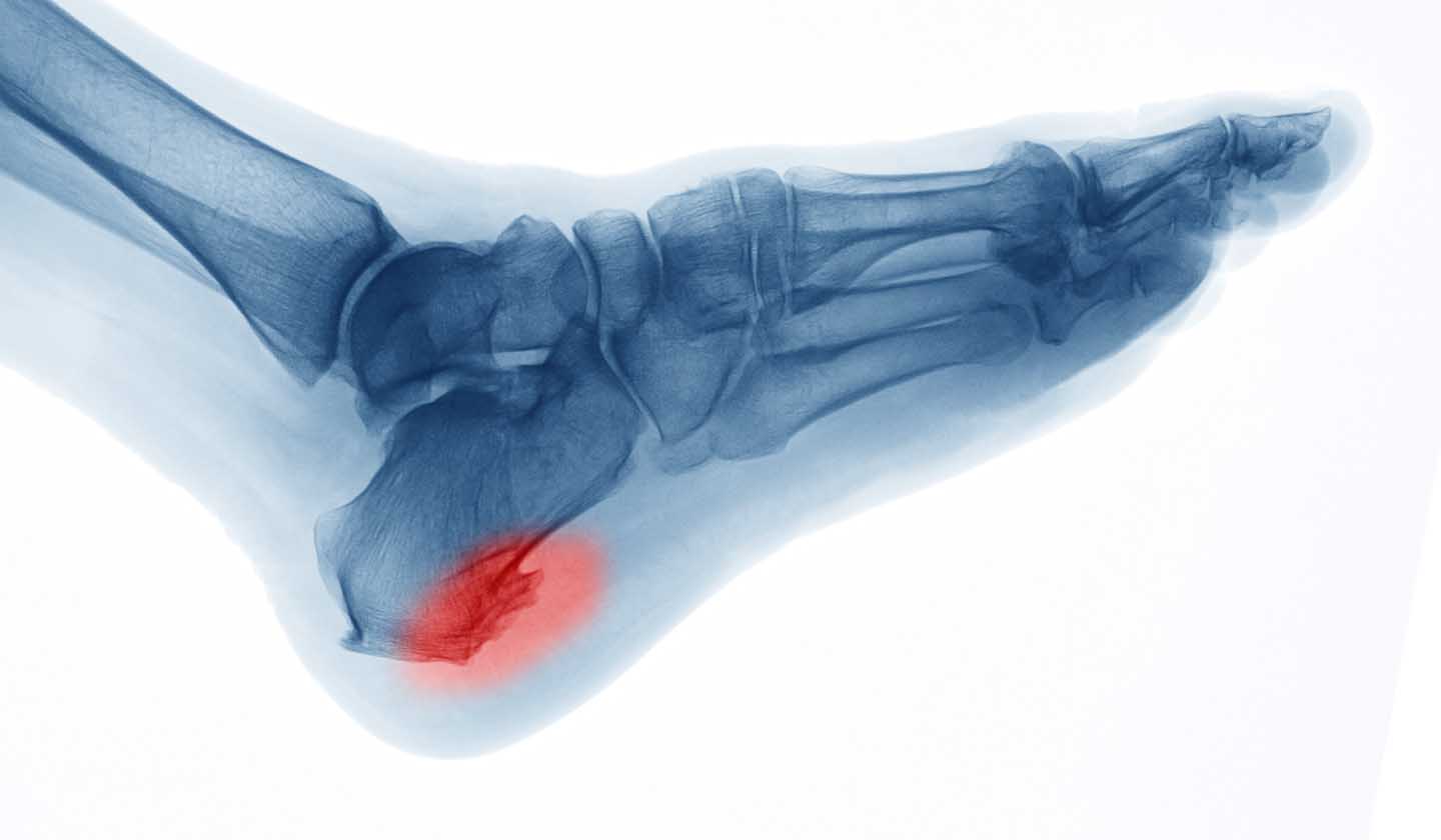 Risk factors for heel spurs