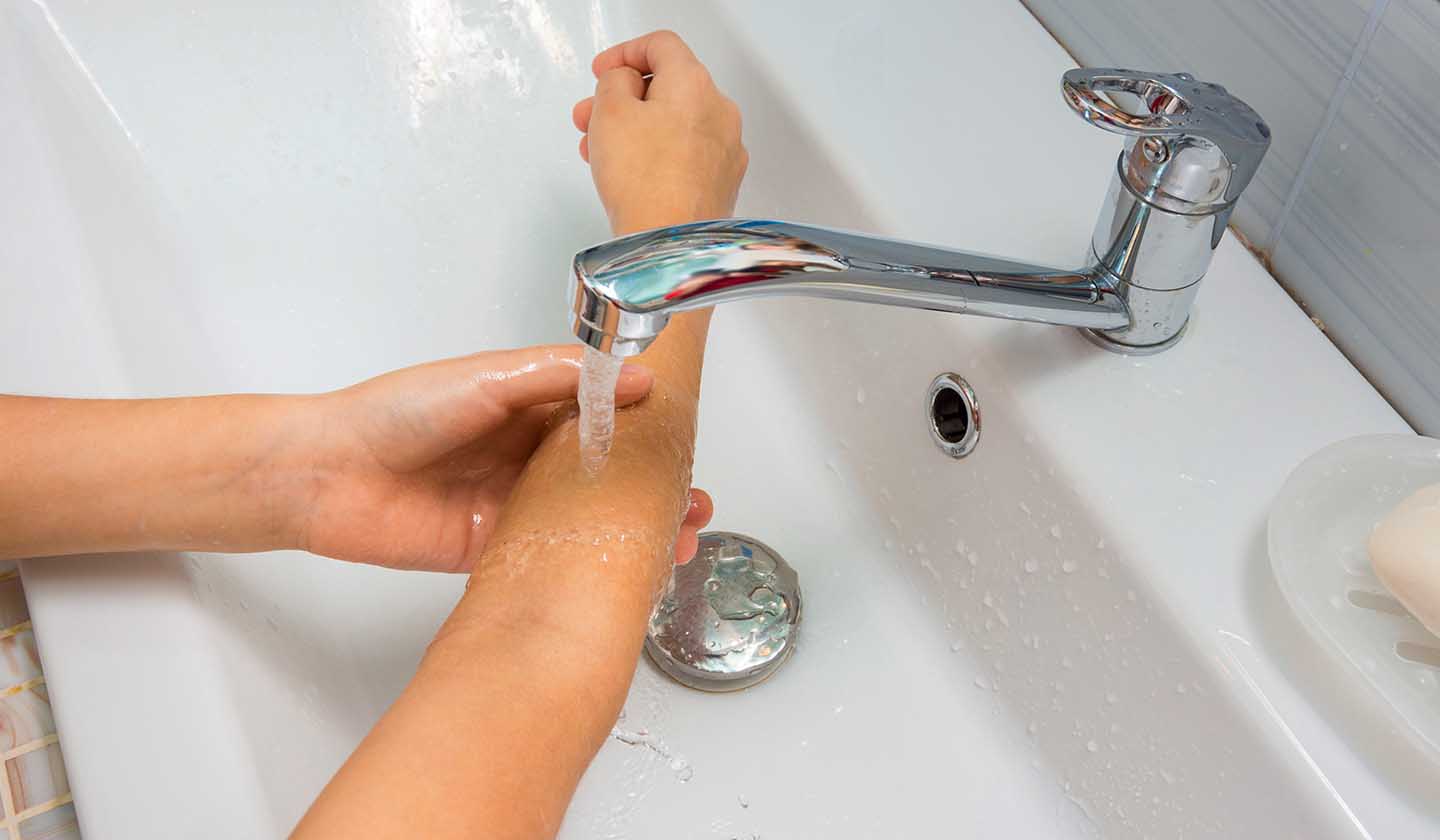 Como agir em caso de queimadura