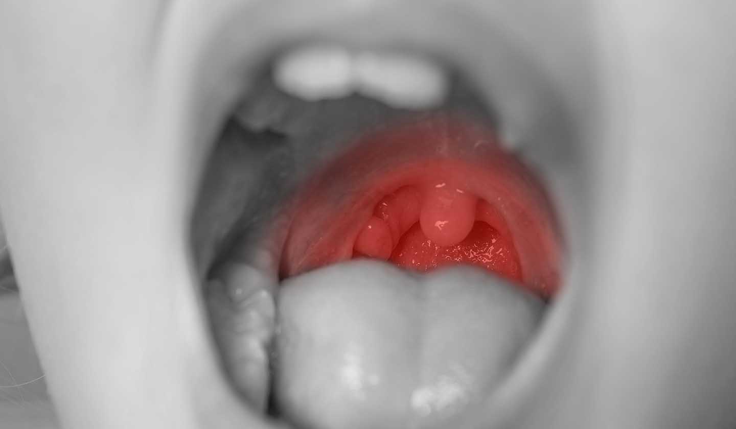 Inflamação da garganta