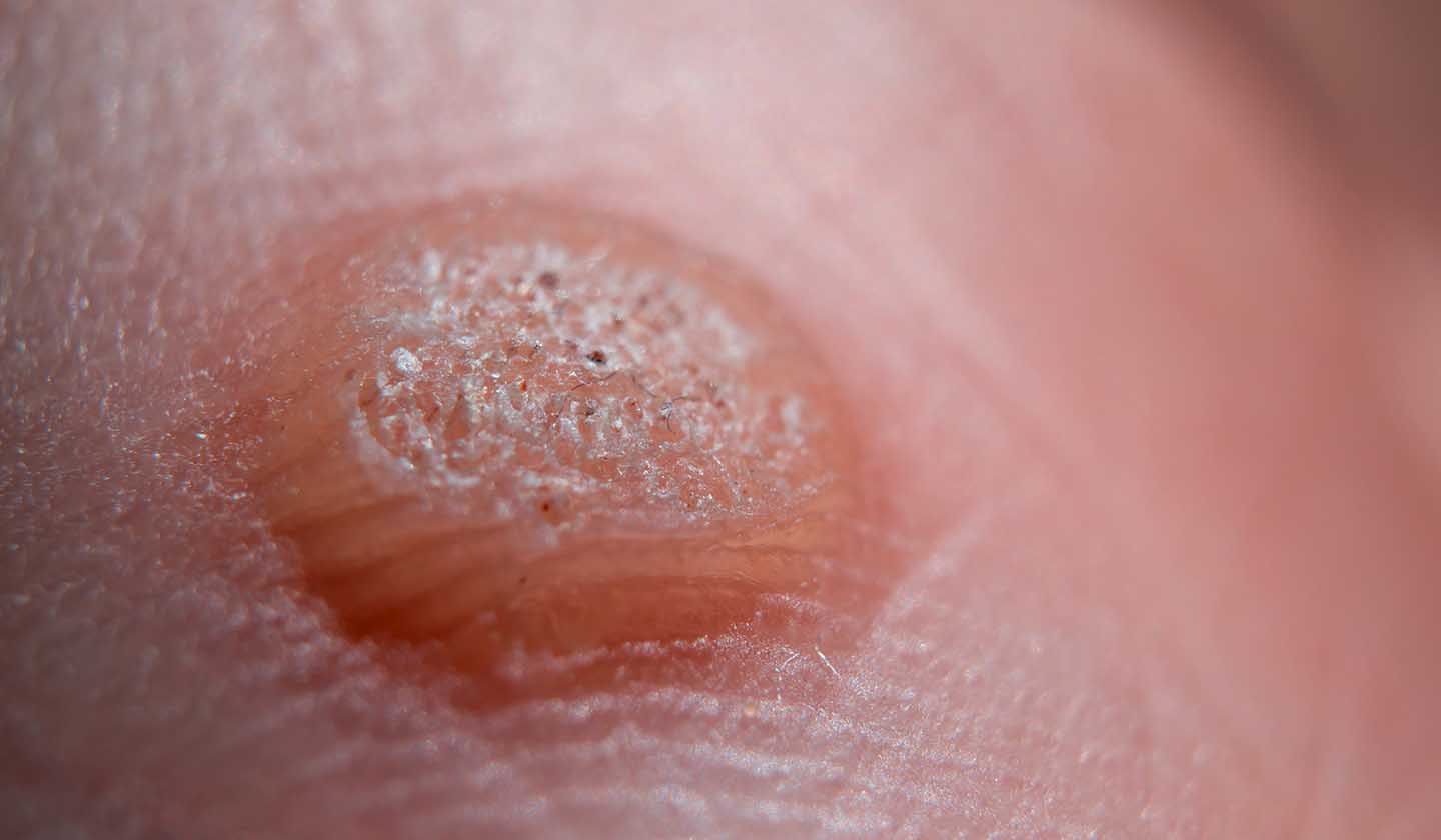 Verrugas plantares - Características