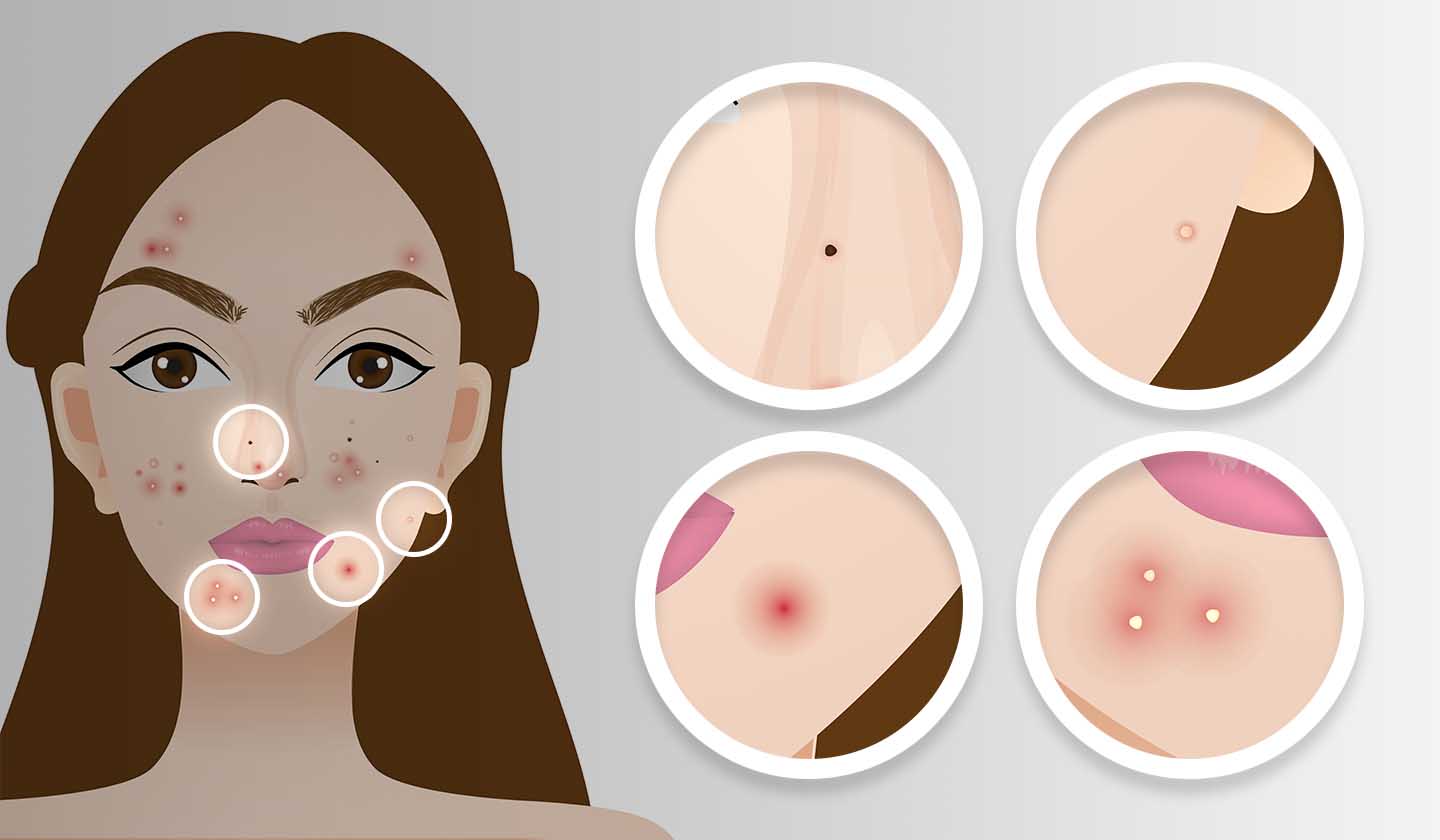 Zonas e manifestações de acne no rosto
