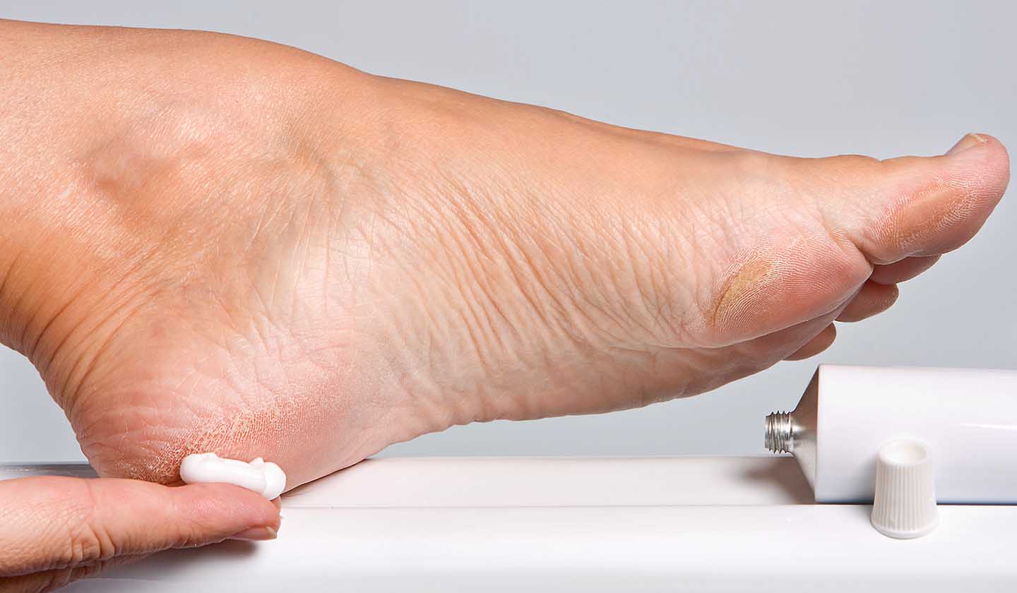 Tratamento dos calos