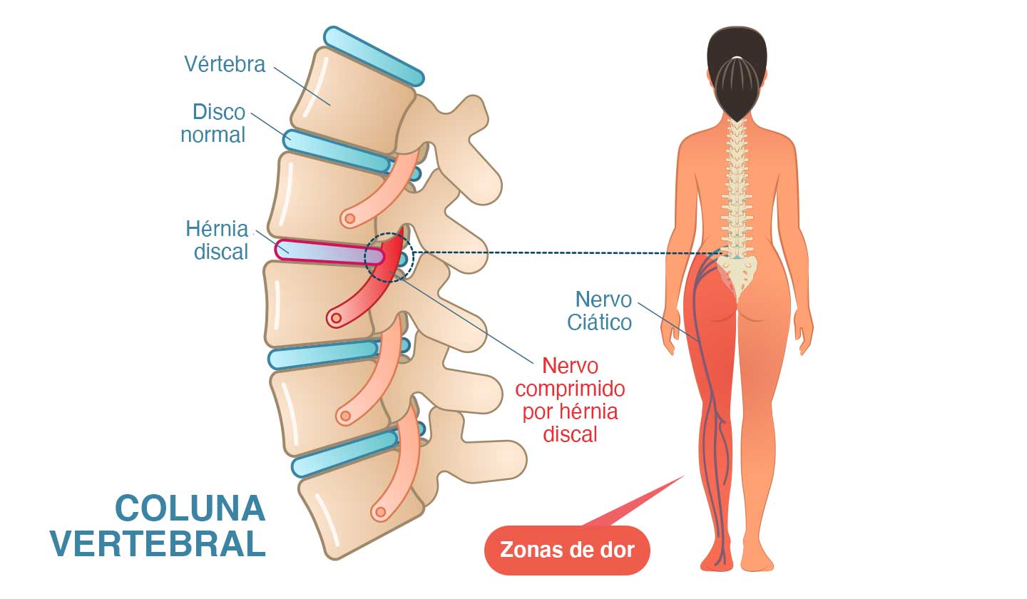 Prevenir Ciática fatores