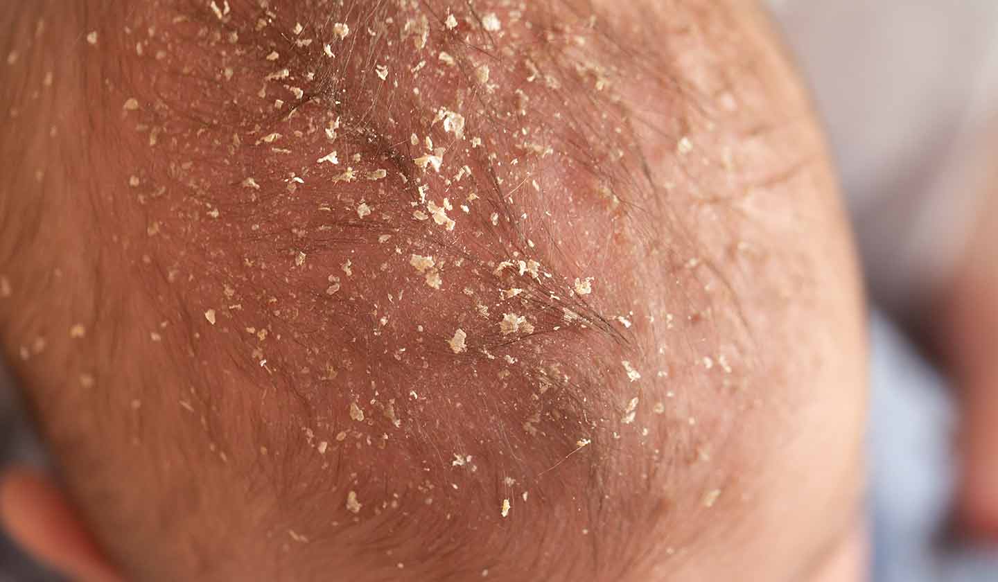 Cradle cap