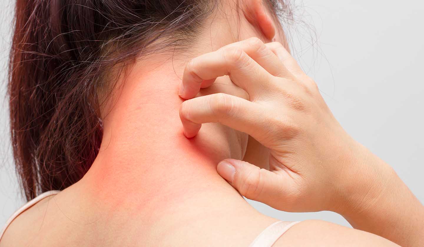 Pele irritada e sensação de comichão