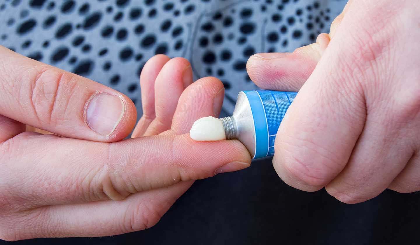 Aplicação de pomada para acalmar e dor