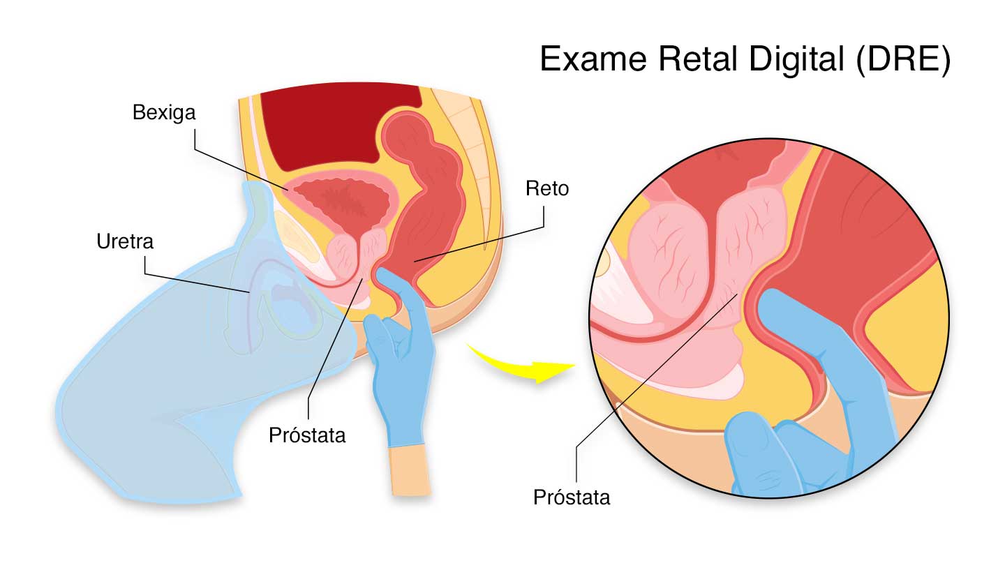 Toque rectal efectuado por urologista