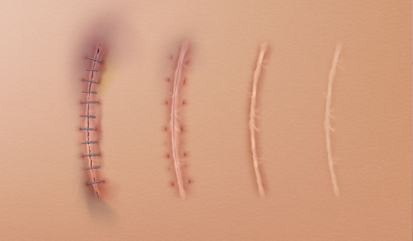 Scar tissue development