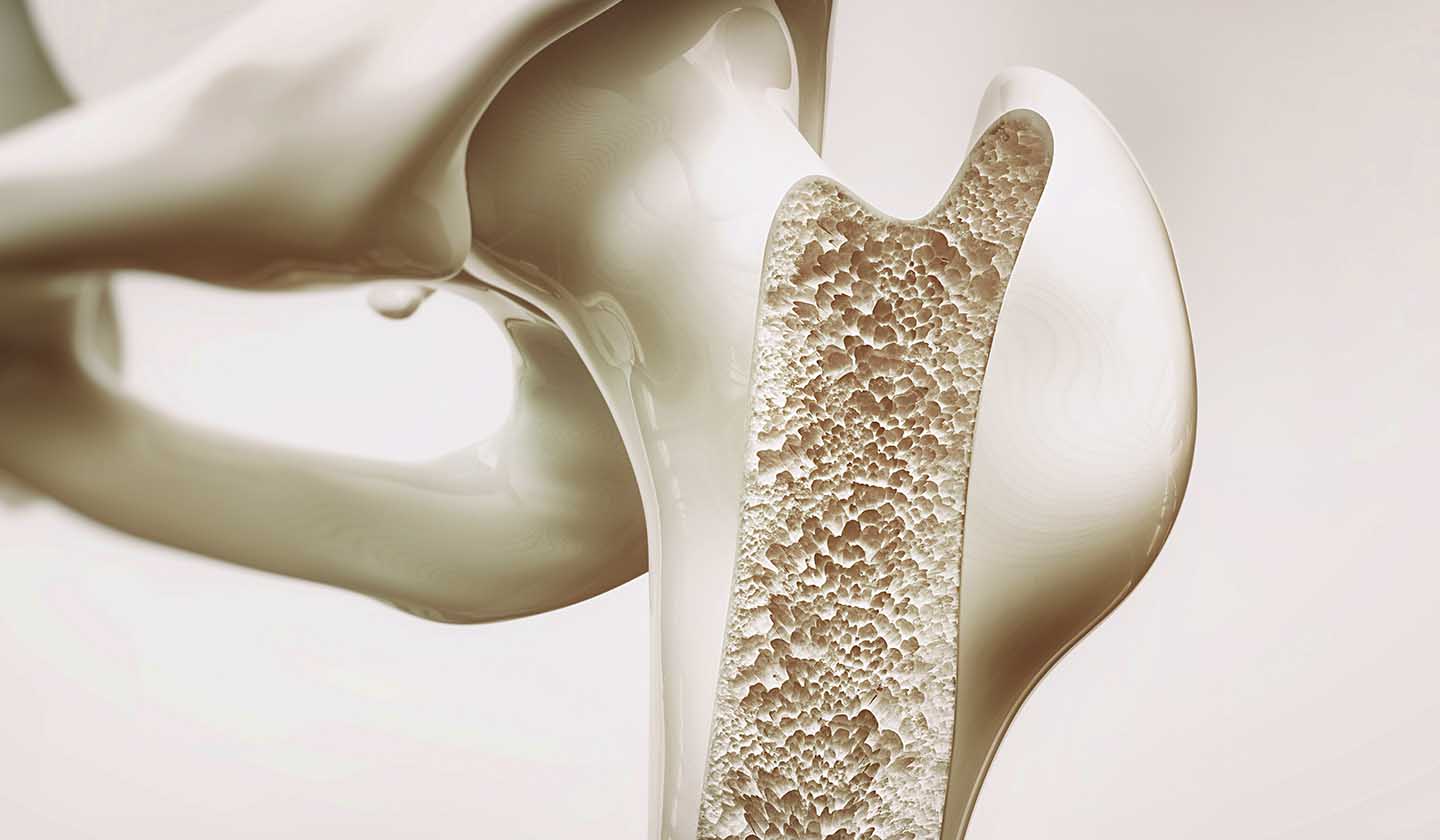 Ossos frágeis