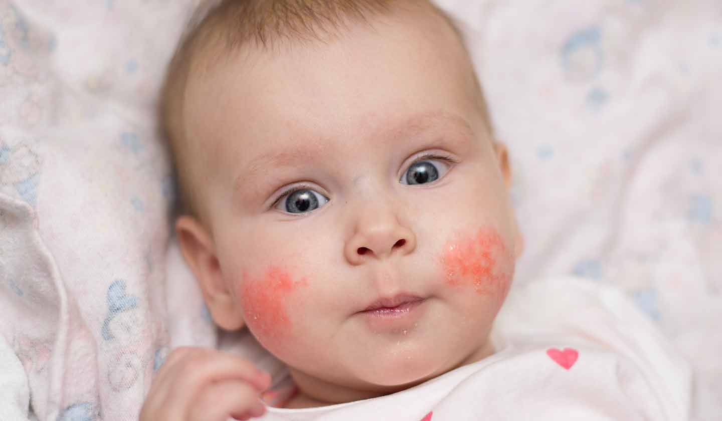 Baby skin care