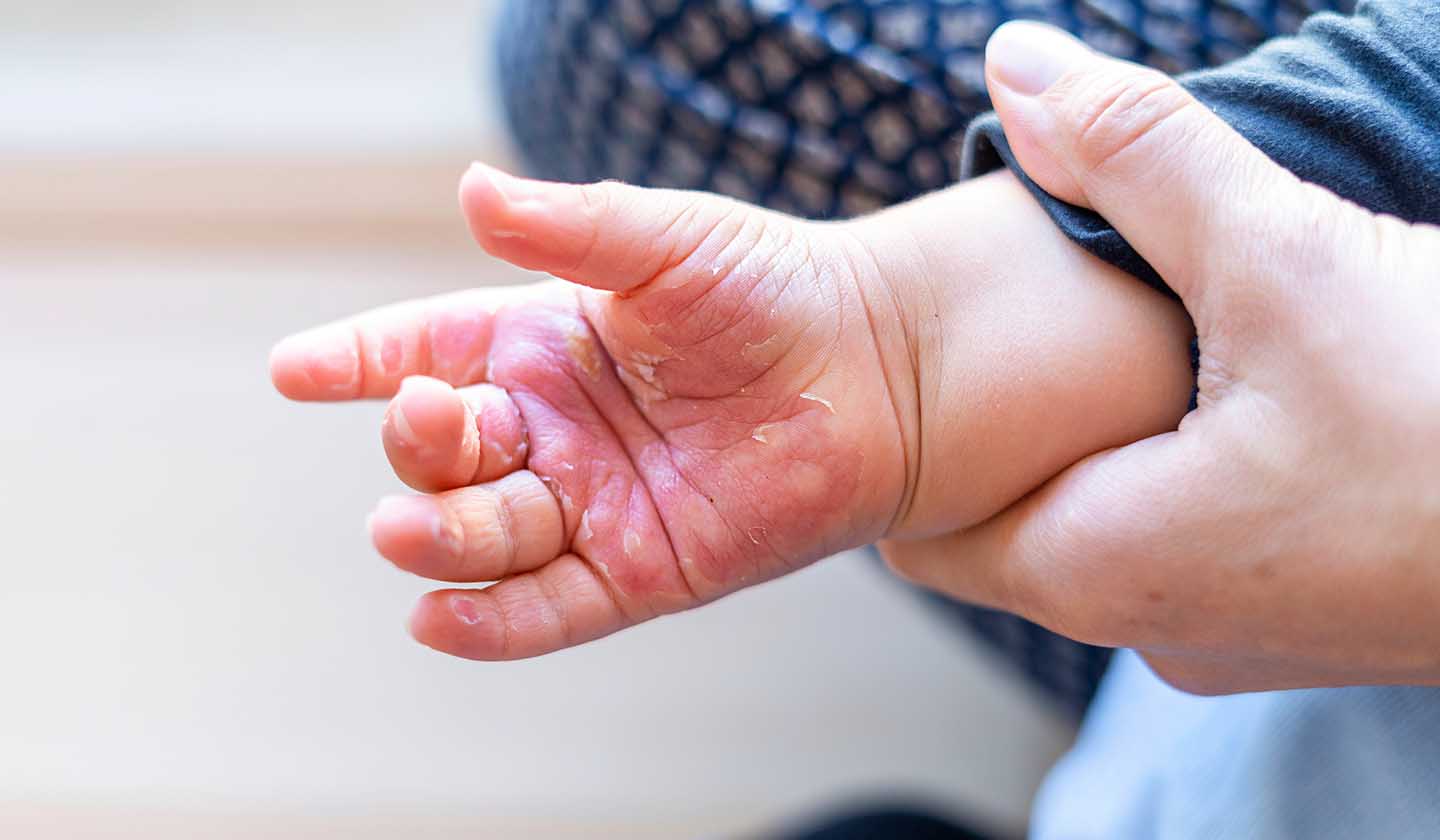 Criança com queimadura na mão