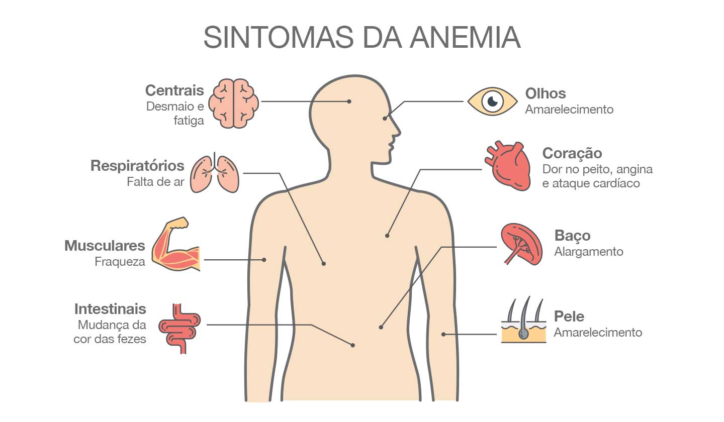 Anemia Ferropénica sinais