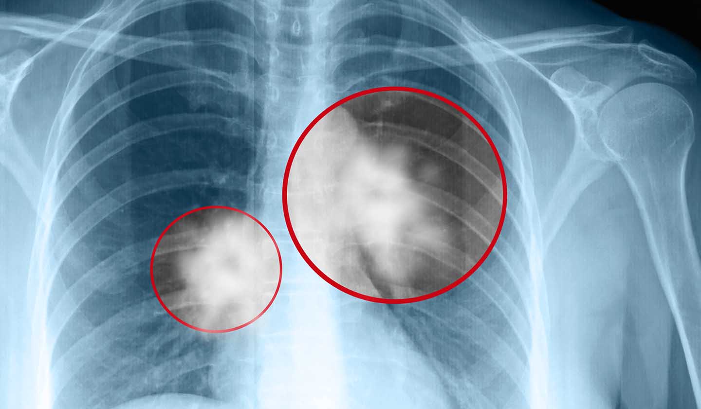 Complicações cardiovasculares e respiratórias