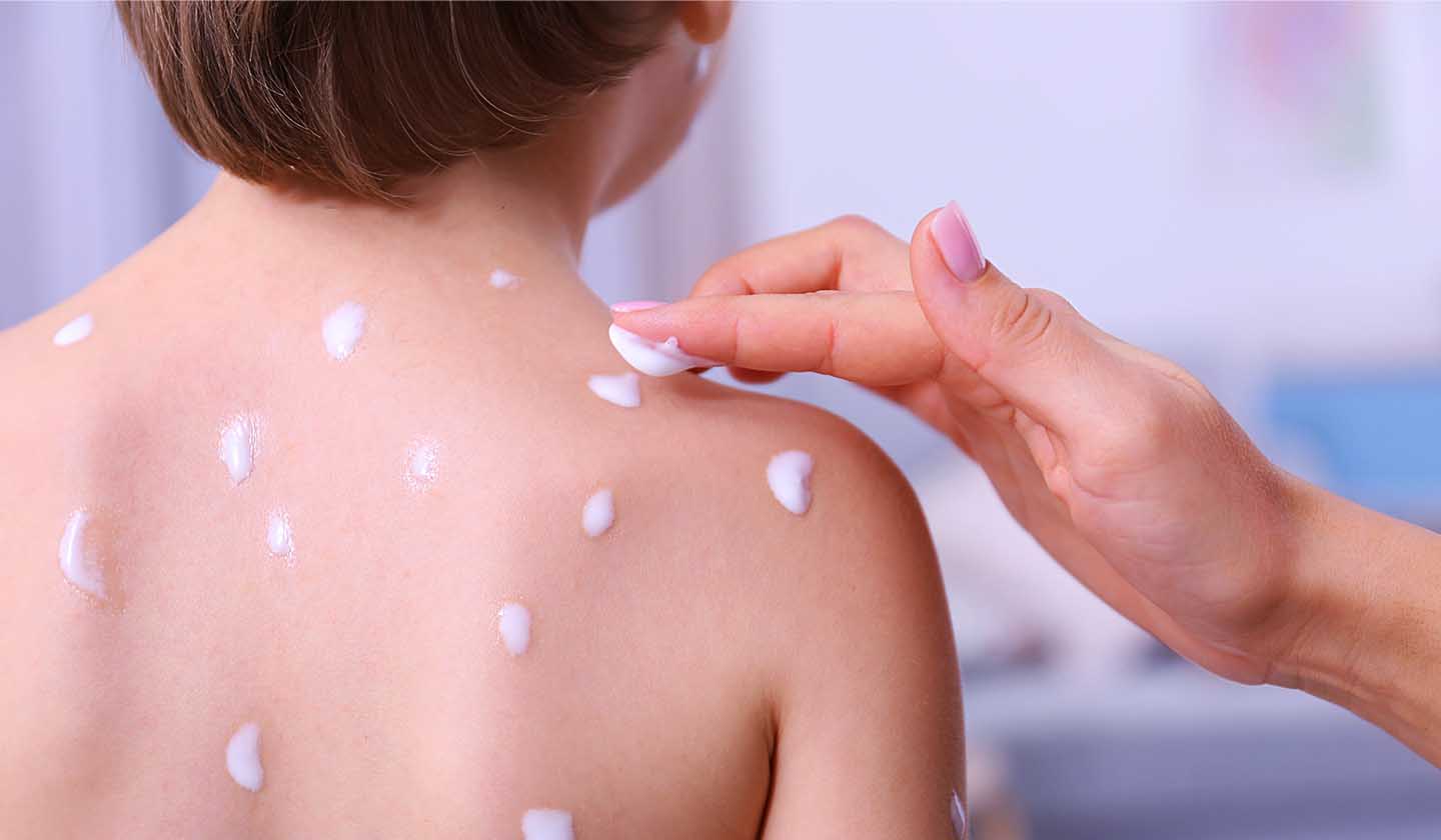 Aplicação de produto para alívio da comichão