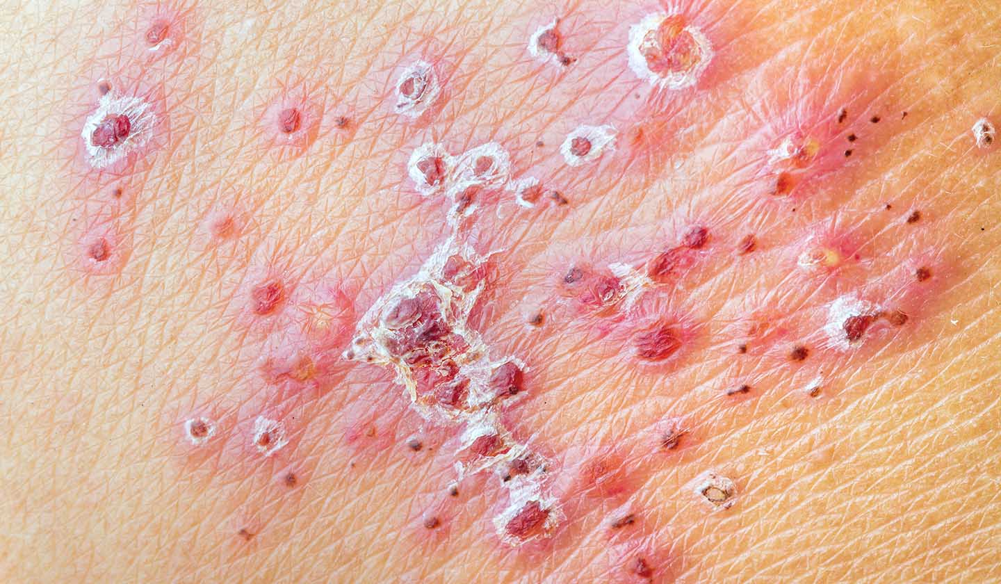 Formação de crostas mais secas